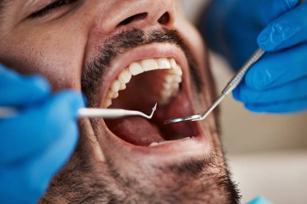 Best Emergency Wisdom Teeth Removal in Wyndmoor, PA